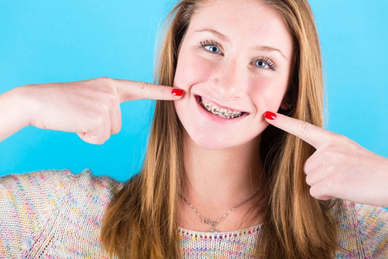 15 drammi di chi ha portato l'apparecchio ai denti OLTREUOMO 15 drammi di chi ha portato l'apparecchio ai denti OLTREUOMO